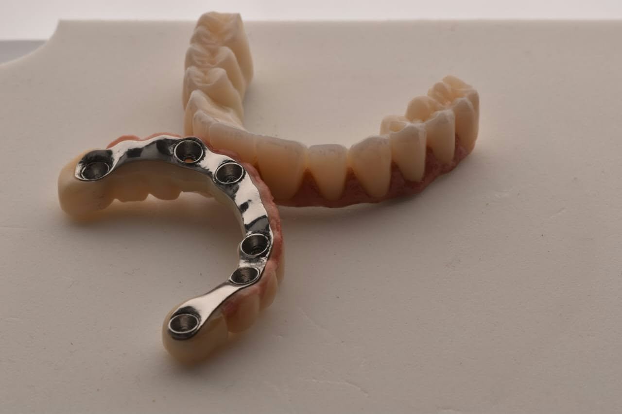 implant birkhadem